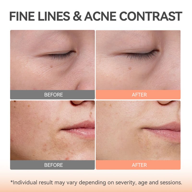 TOUCHBeauty GLAM LED Light Therapy Mask | Clear, Brighten & Rejuvenate Skin - TOUCHBeauty