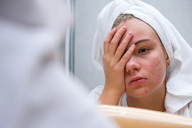 Oily Skin: Causes and Treatments - TOUCHBeauty