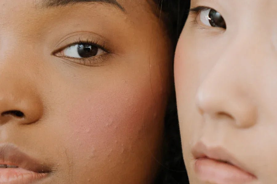The Best Skin Care Routine for Treating Acne-Prone Skin - TOUCHBeauty